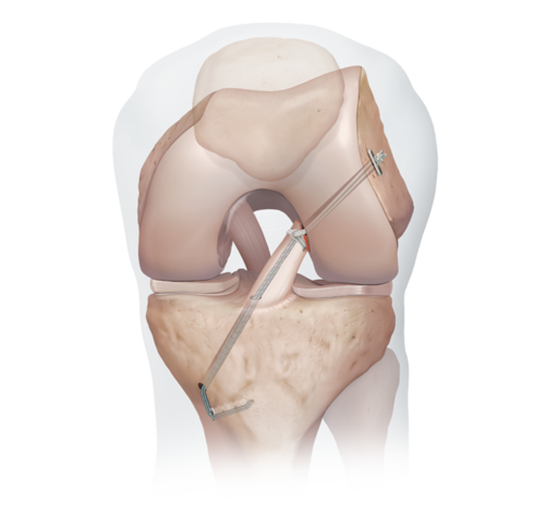 ACL-Primary-Repair-with-InternaBrace-Collection