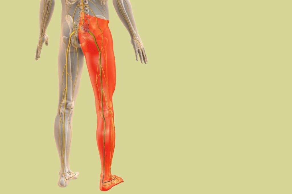 Sciatica Pain