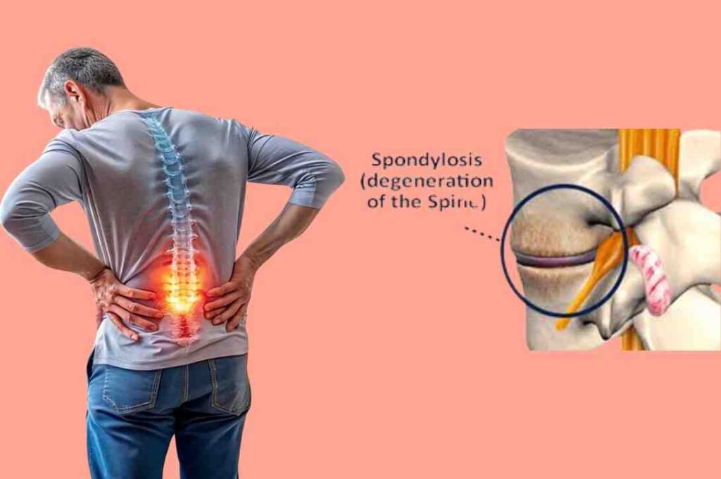 Lumbar Spondylosis