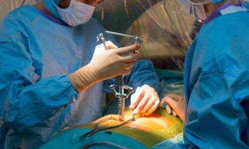 Minimally Invasive Spinal Fusion