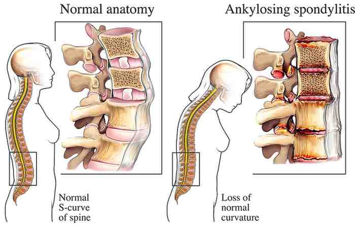 Ankylosing Spondylitis Treatment in Faridabad