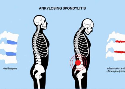 What Is Ankylosing Spondylitis