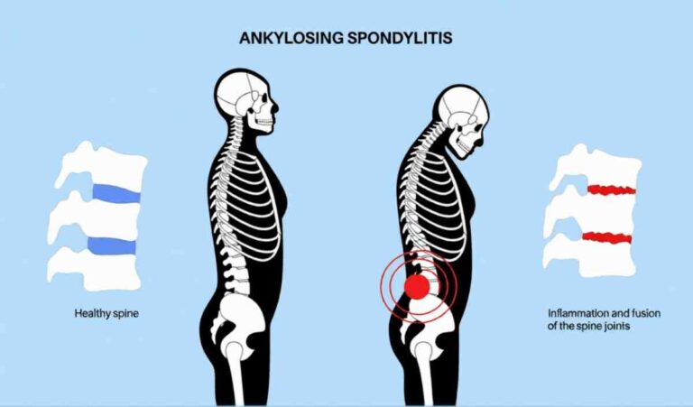 What Is Ankylosing Spondylitis and Treatment