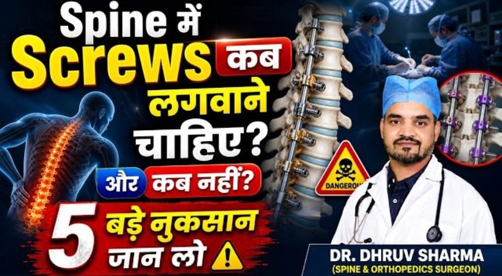 When are spinal screws necessary?