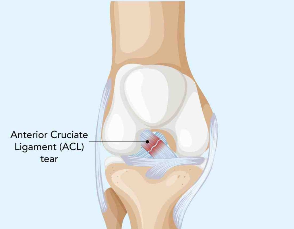 ACL INJURY